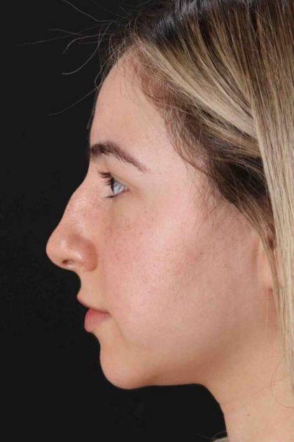 Rhinoplasty Before & After Patient #3247
