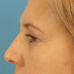 Browlift Before & After Patient #1402