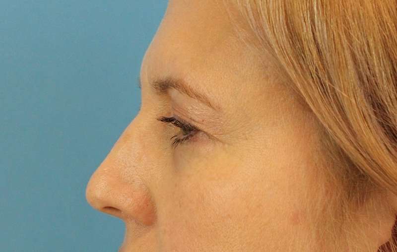 Browlift Before & After Patient #1402