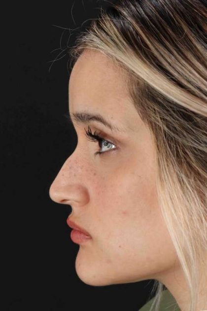 Rhinoplasty Before & After Patient #3258