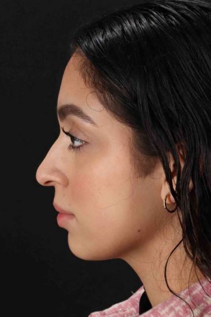 Rhinoplasty Before & After Patient #3269