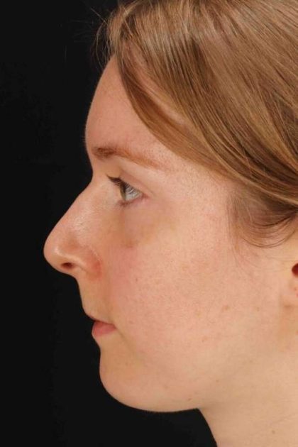 Rhinoplasty Before & After Patient #3280