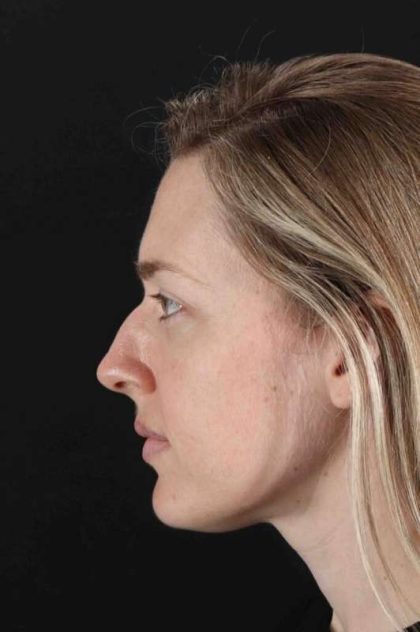 Rhinoplasty Before & After Patient #3291