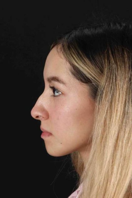 Rhinoplasty Before & After Patient #3302