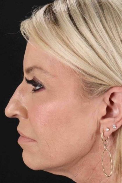 Co2 Laser Before & After Patient #3335