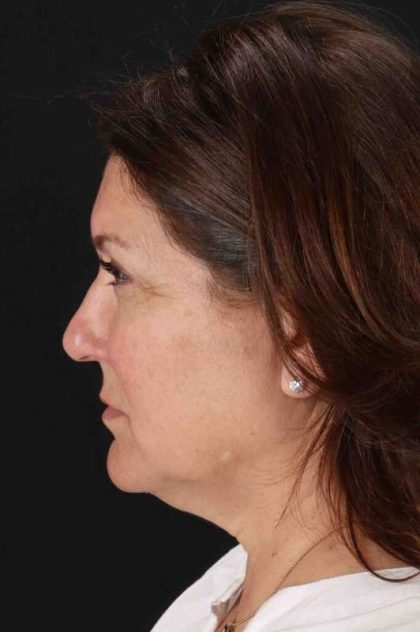 Co2 Laser Before & After Patient #3357