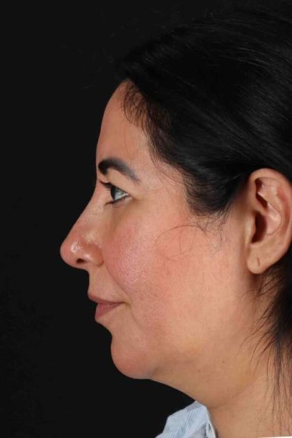 Upper Blepharoplasty Before & After Patient #3456