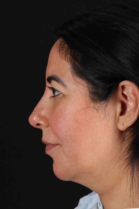 Upper Blepharoplasty Before & After Patient #3456