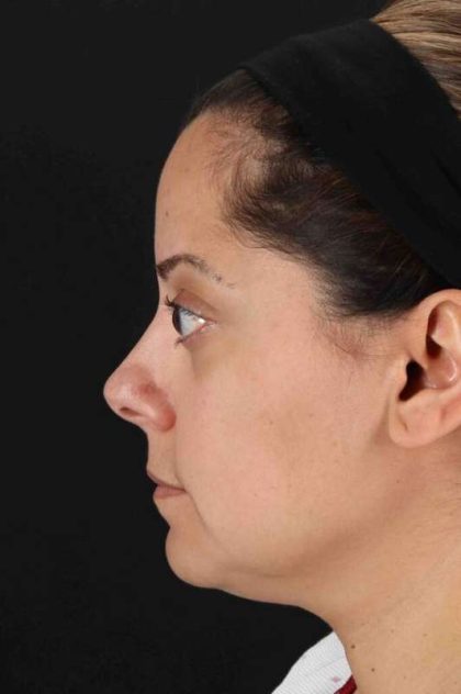 Buccal Fat Pad Before & After Patient #1436