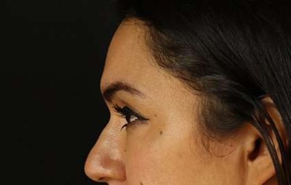 Upper Blepharoplasty Before & After Patient #3522