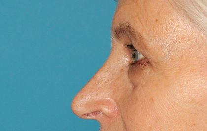 Upper Blepharoplasty Before & After Patient #3532