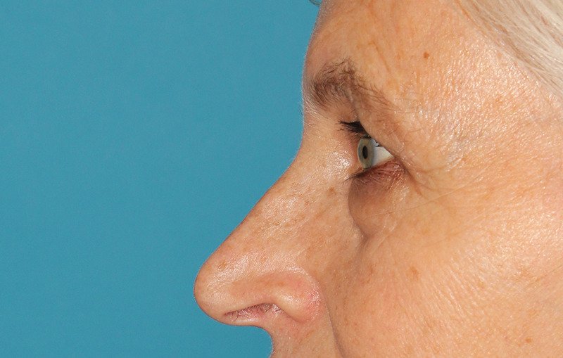 Upper Blepharoplasty Before & After Patient #3532