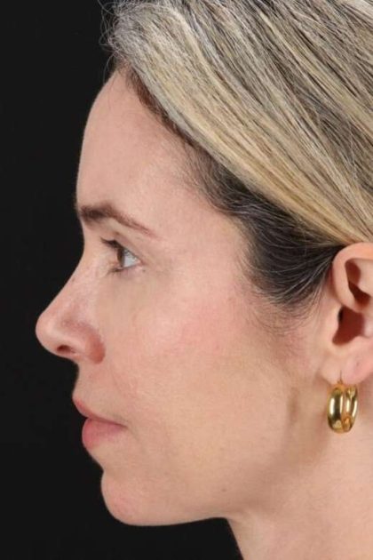Browlift Before & After Patient #1231