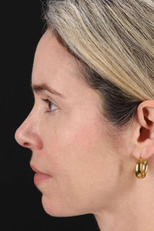 Browlift Before & After Patient #1231