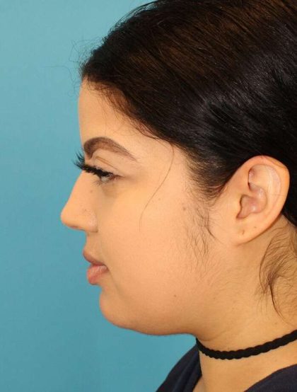 Buccal Fat Pad Before & After Patient #1485