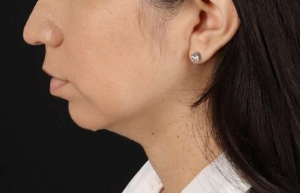 Chin Implant Before & After Patient #1540