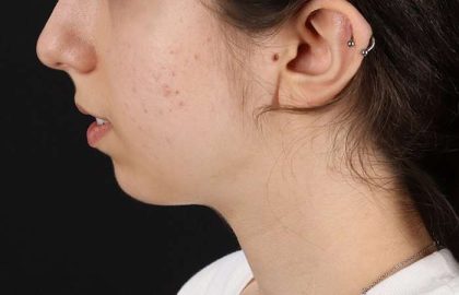 Chin Implant Before & After Patient #1551