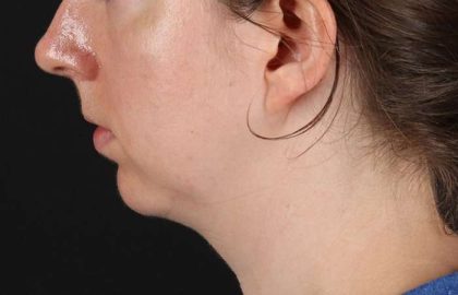 Chin Implant Before & After Patient #1562