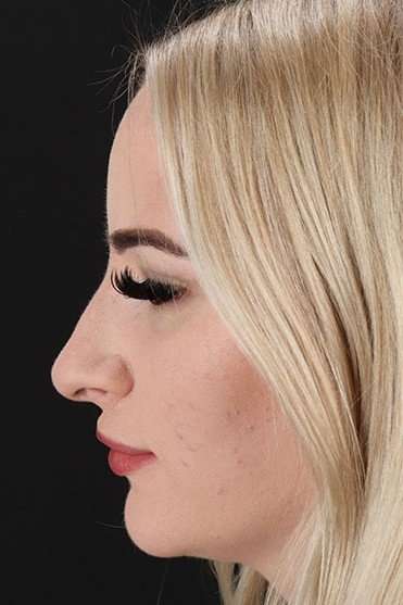 Browlift Before & After Patient #1242