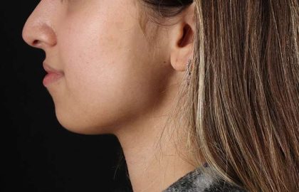 Chin Implant Before & After Patient #1573