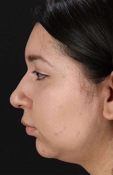 Chin Implant Before & After Patient #1604