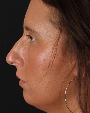 Chin Implant Before & After Patient #1615