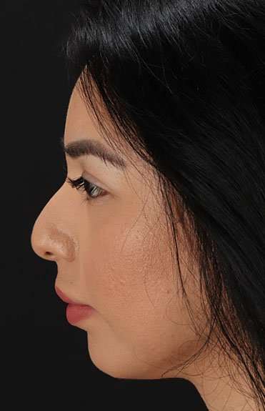 Chin Implant Before & After Patient #1626