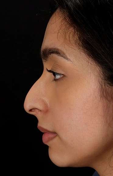 Chin Implant Before & After Patient #1637