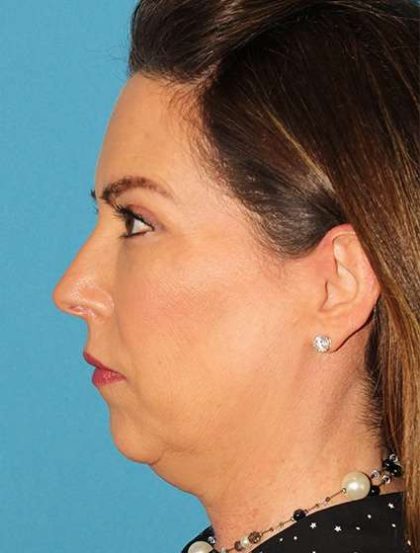 Chin Implant Before & After Patient #1659