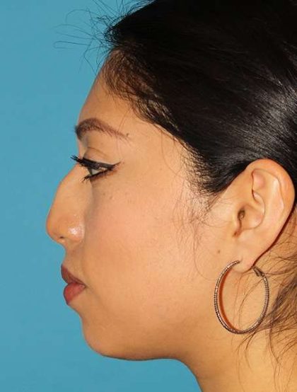 Chin Implant Before & After Patient #1670