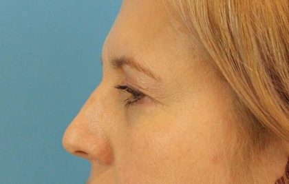 Eyelid Lift Before & After Patient #1747