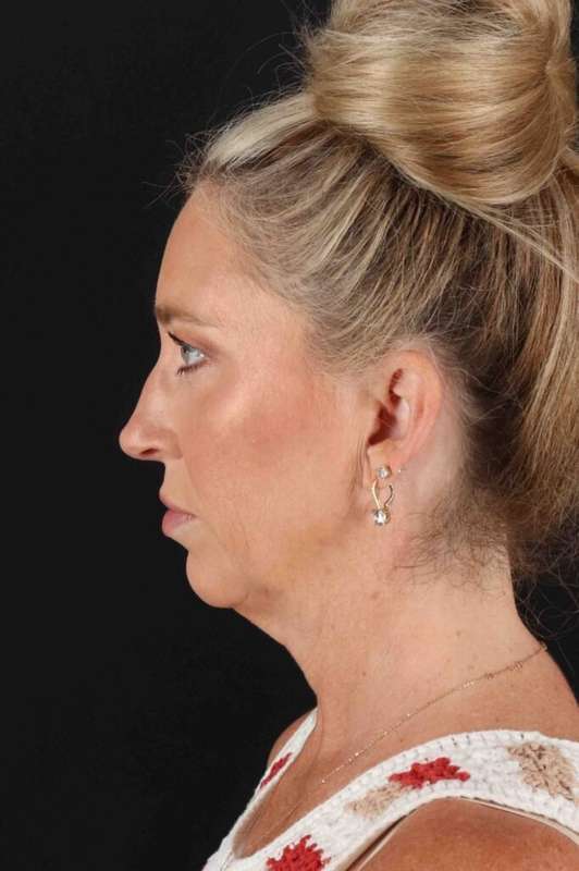 Facelift Before & After Patient #1778