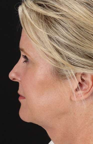 Facelift Before & After Patient #1877