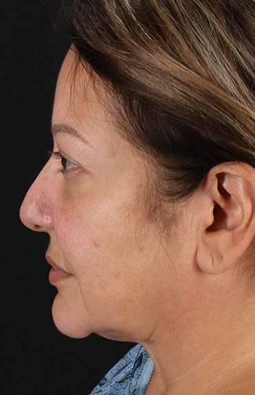 Facelift Before & After Patient #1888