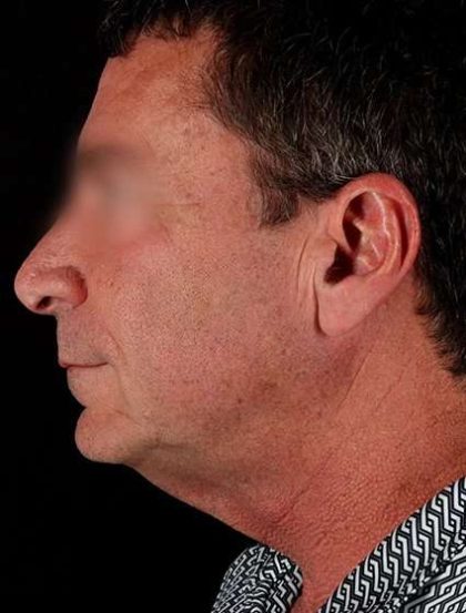 Facelift Before & After Patient #1899