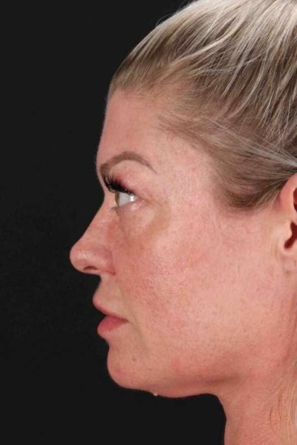 Fat Grafting To The Face Before & After Patient #2016