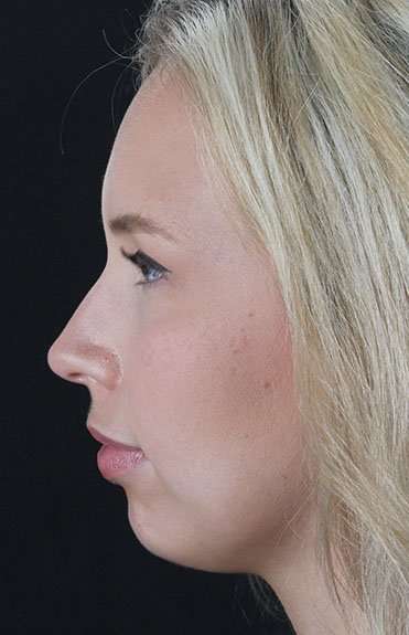 Fillers Before & After Patient #2030