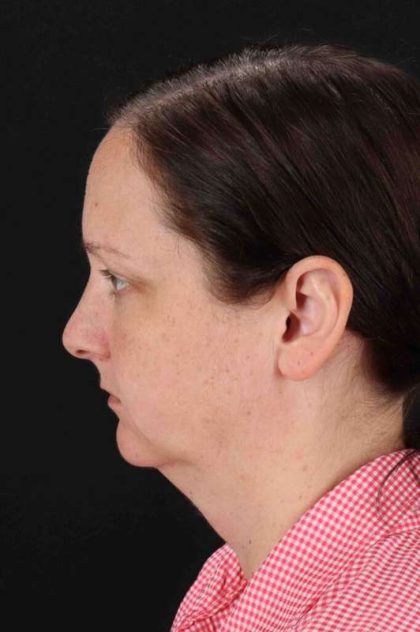 Browlift Before & After Patient #1275