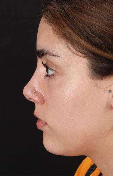 Fillers Before & After Patient #2052