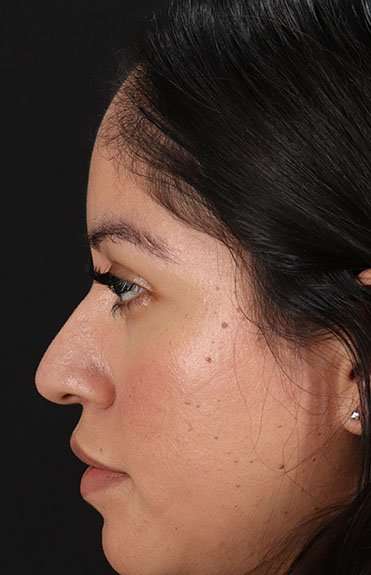Fillers Before & After Patient #2063