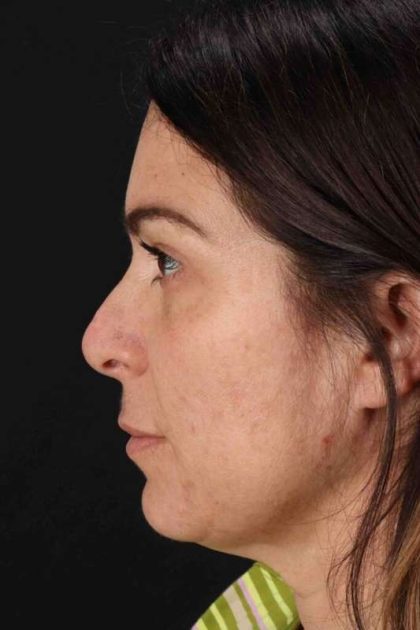 Lip Lift Before & After Patient #2133