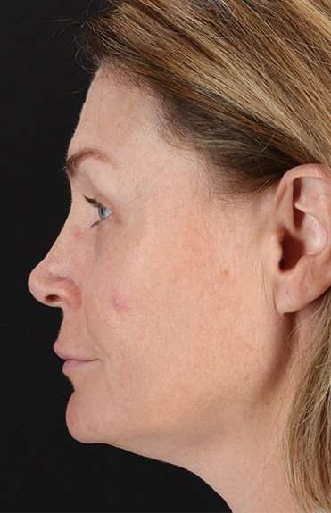 Lip Lift Before & After Patient #2144