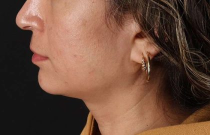 Lip Lift Before & After Patient #2166