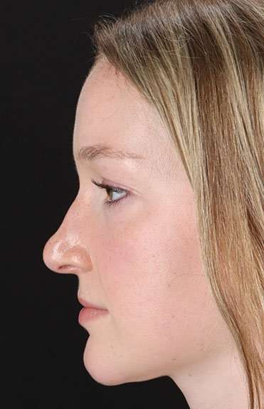 Liquid Rhinoplasty Before & After Patient #2177