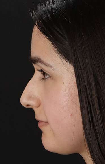 Liquid Rhinoplasty Before & After Patient #2188
