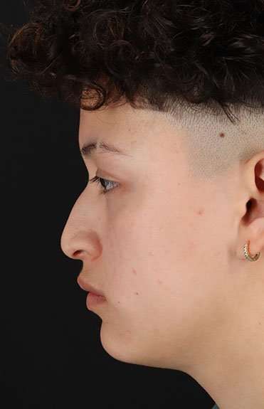 Liquid Rhinoplasty Before & After Patient #2199