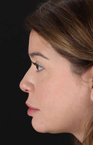 Liquid Rhinoplasty Before & After Patient #2210