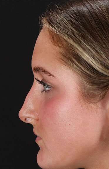Liquid Rhinoplasty Before & After Patient #2221