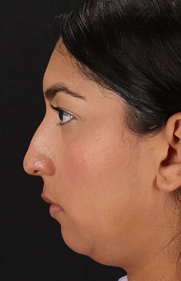 Liquid Rhinoplasty Before & After Patient #2232