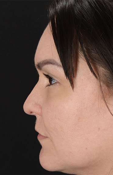Liquid Rhinoplasty Before & After Patient #2243